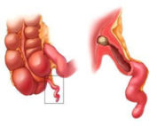 Apendicite Gastrovale Gastroenterologia Coloproctologia E Cirurgia