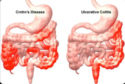 Doen As Intestinais Gastrovale Gastroenterologia Coloproctologia E