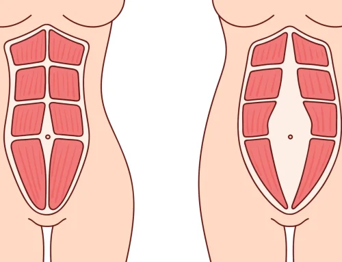 DIASTÁSTASE ABDOMINAL